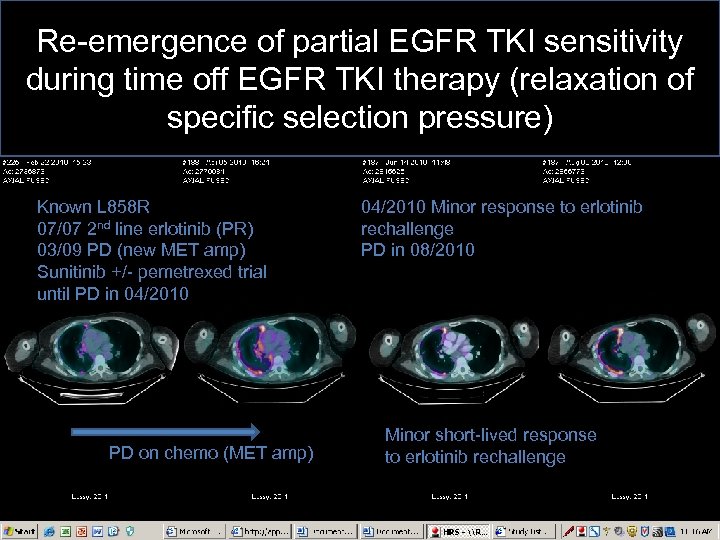 Re-emergence of partial EGFR TKI sensitivity during time off EGFR TKI therapy (relaxation of