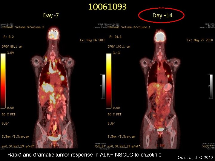 Rapid and dramatic tumor response in ALK+ NSCLC to crizotinib Ou et al, JTO