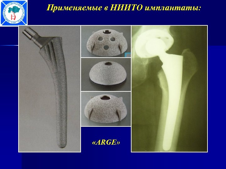 Применяемые в НИИТО имплантаты: «ARGE» 