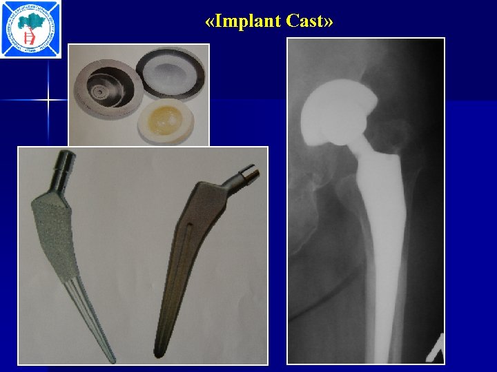  «Implant Cast» 