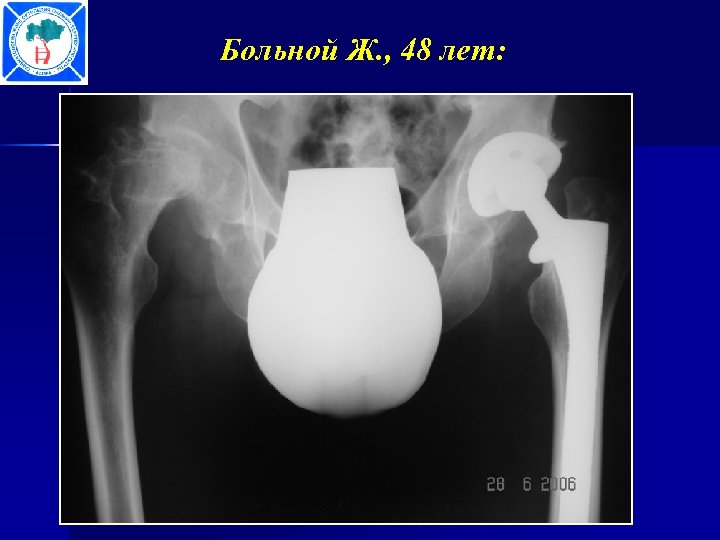 Больной Ж. , 48 лет: 