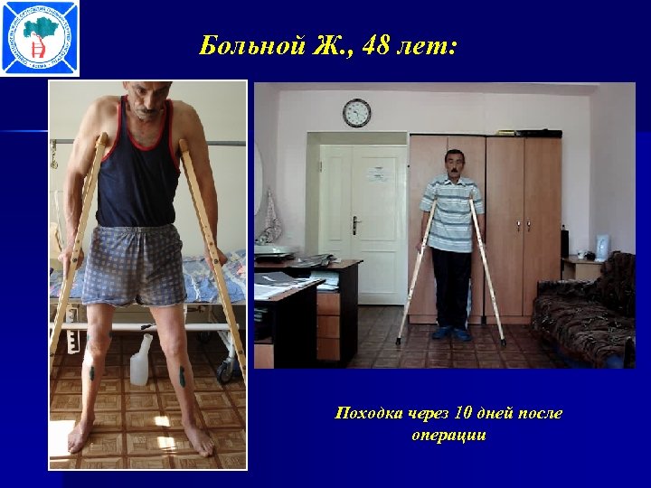 Больной Ж. , 48 лет: Походка через 10 дней после операции 