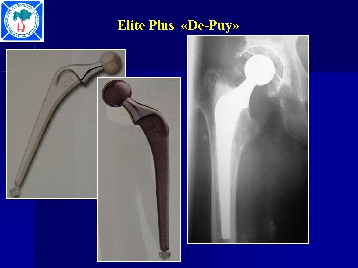 Elite Plus «De-Puy» 