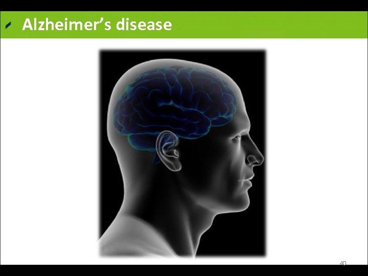 Alzheimer’s disease 40 
