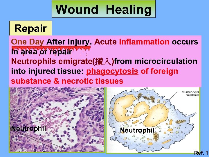 Wound Healing Repair One Day After Injury. Acute inflammation occurs in area of repair