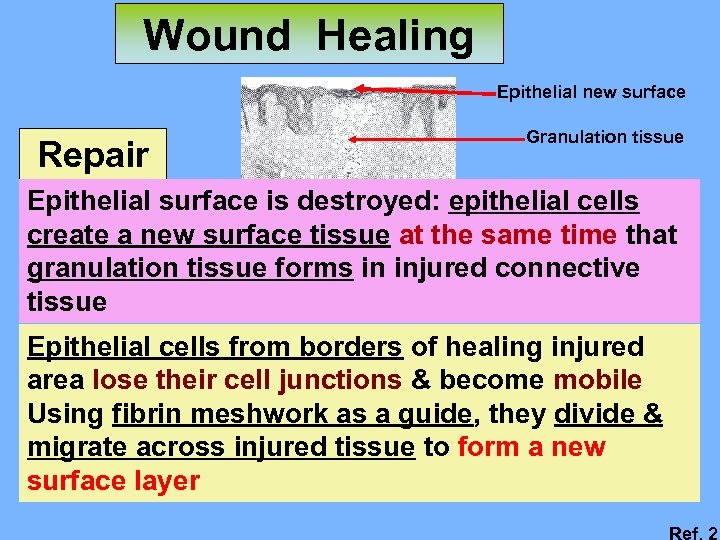 Wound Healing Epithelial new surface Repair Granulation tissue Epithelial surface is destroyed: epithelial cells