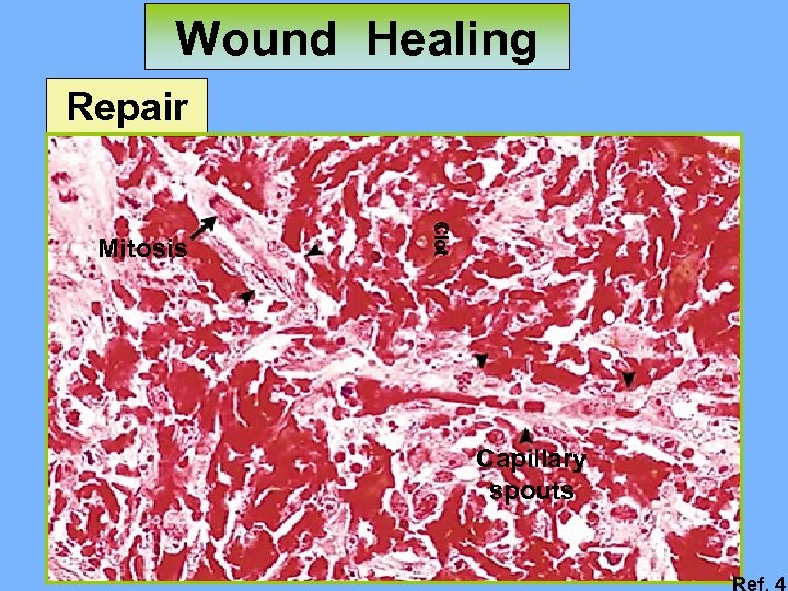 Wound Healing Repair Clot Mitosis Capillary spouts Ref. 4 