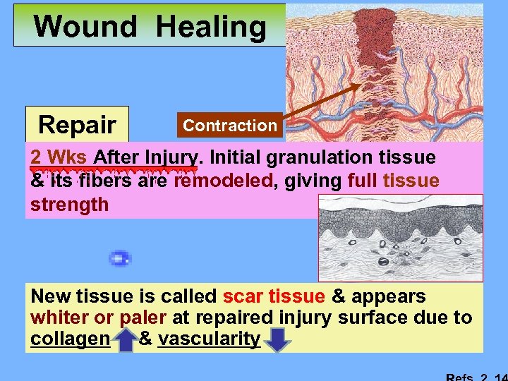 Wound Healing Repair Contraction 2 Wks After Injury. Initial granulation tissue & its fibers