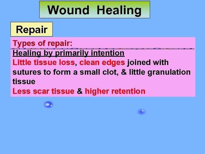 Wound Healing Repair Types of repair: Healing by primarily intention Little tissue loss, clean