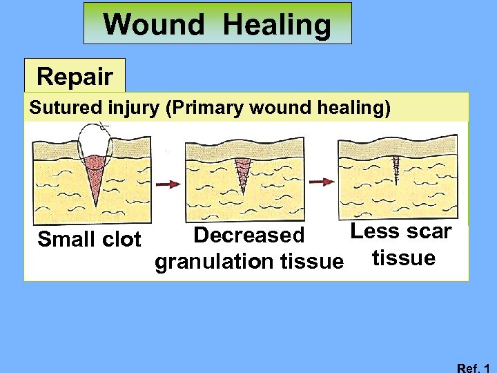 Wound Healing Repair Sutured injury (Primary wound healing) Small clot Less scar Decreased granulation