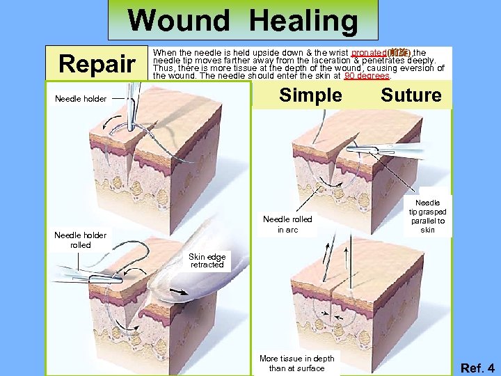 Wound Healing Repair When the needle is held upside down & the wrist pronated(前旋),