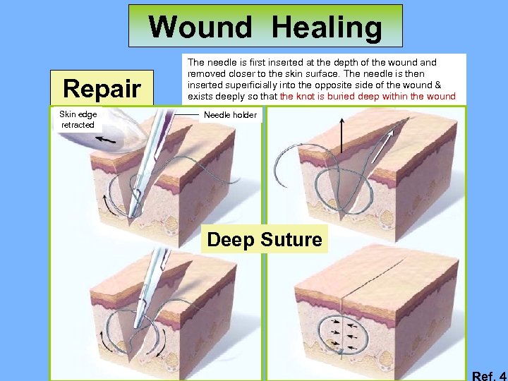 Wound Healing Repair Skin edge retracted The needle is first inserted at the depth