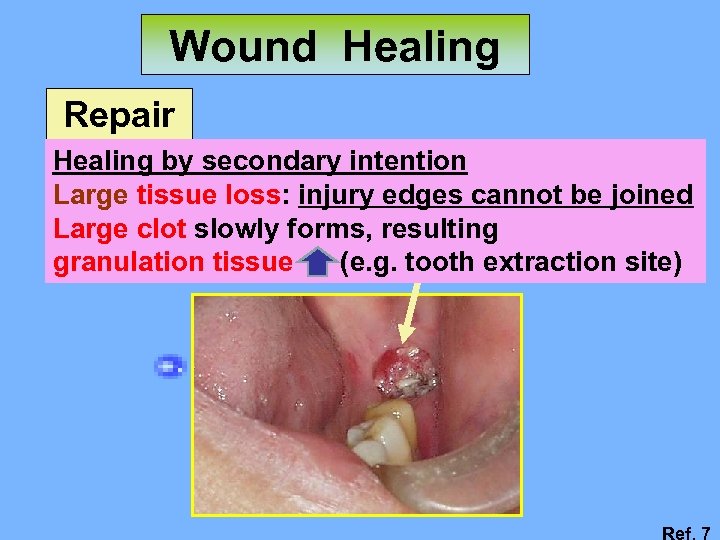 Wound Healing Repair Healing by secondary intention Large tissue loss: injury edges cannot be