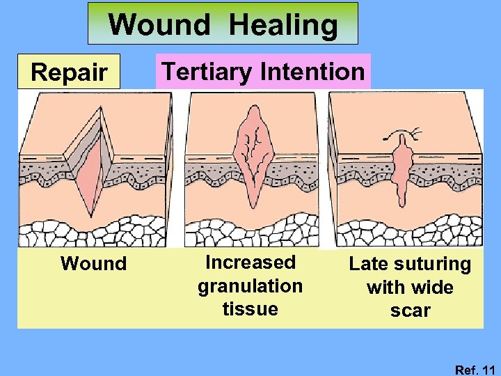 Wound Healing Repair Wound Tertiary Intention Increased granulation tissue Late suturing with wide scar