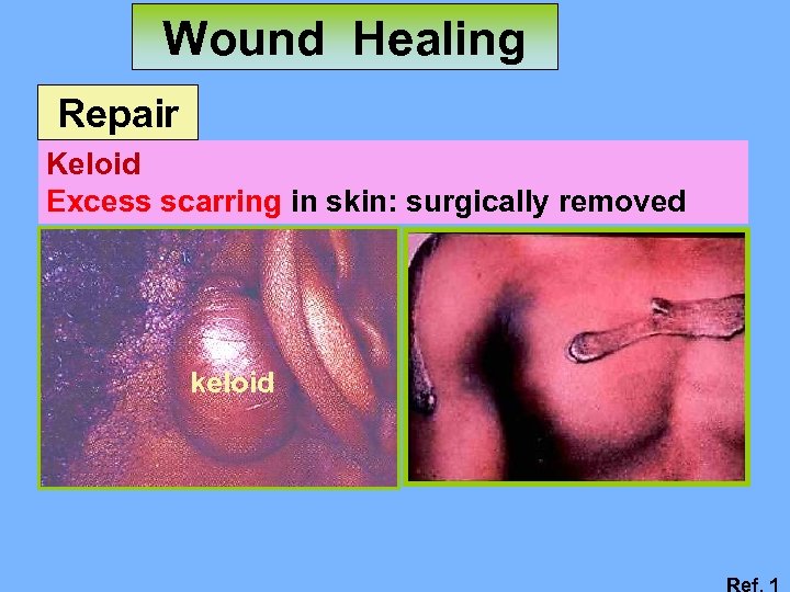 Wound Healing Repair Keloid Excess scarring in skin: surgically removed keloid Ref. 1 