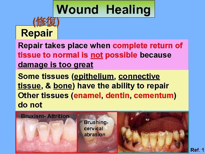 Wound Healing (修復) Repair takes place when complete return of tissue to normal is