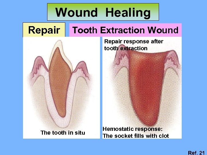 Wound Healing Repair Tooth Extraction Wound Repair response after tooth extraction The tooth in