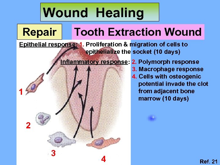 Wound Healing Repair Tooth Extraction Wound Epithelial response: 1. Proliferation & migration of cells