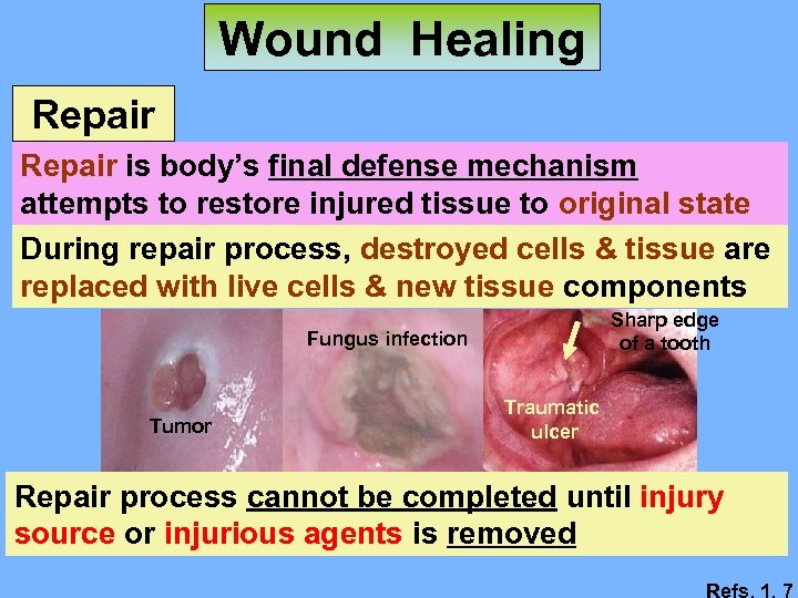 Wound Healing Repair is body’s final defense mechanism attempts to restore injured tissue to