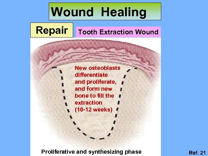 Wound Healing Repair Tooth Extraction Wound New osteoblasts differentiate and proliferate, and form new