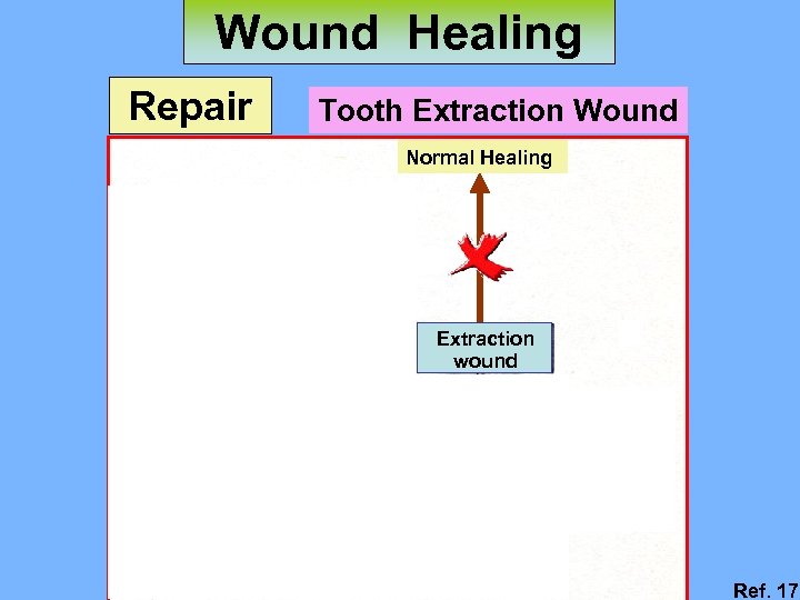 Wound Healing Repair Tooth Extraction Wound Normal Healing Extraction wound Delayed Healing (dry socket)