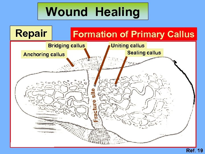 Wound Healing Repair Formation of Primary Callus Bridging callus Uniting callus Sealing callus Fracture