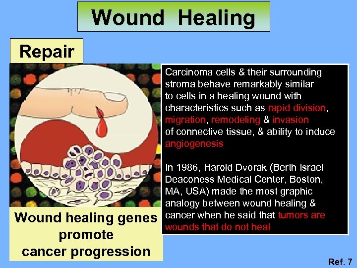 Wound Healing Repair Carcinoma cells & their surrounding stroma behave remarkably similar to cells