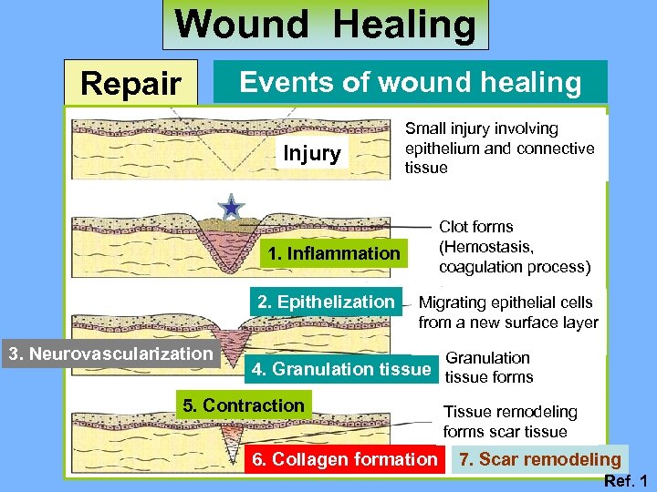 Wound Healing Repair Events of wound healing Injury Small injury involving epithelium and connective