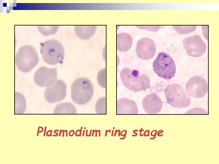 Plasmodium ring stage 