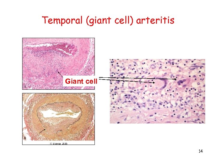 Temporal (giant cell) arteritis Giant cell 14 