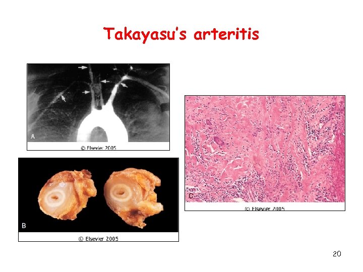 Takayasu’s arteritis 20 