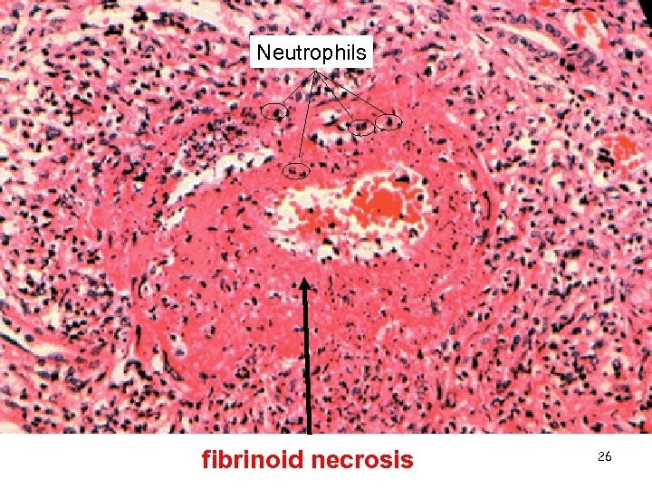 Neutrophils fibrinoid necrosis 26 