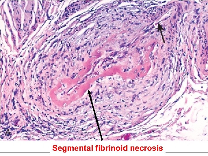 Segmental fibrinoid necrosis 27 