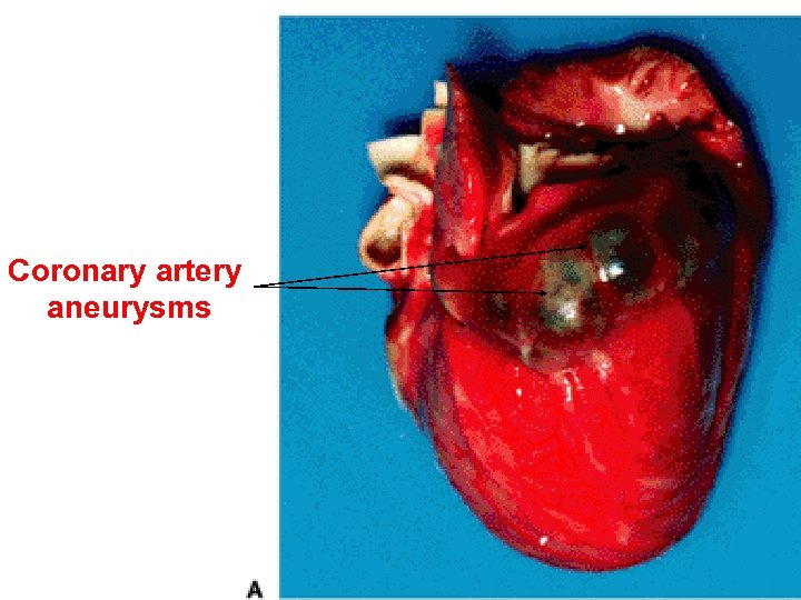 Coronary artery aneurysms 35 