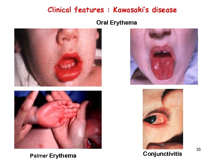 Clinical features : Kawasaki’s disease Oral Erythema Palmer Erythema Conjunctivitis 36 