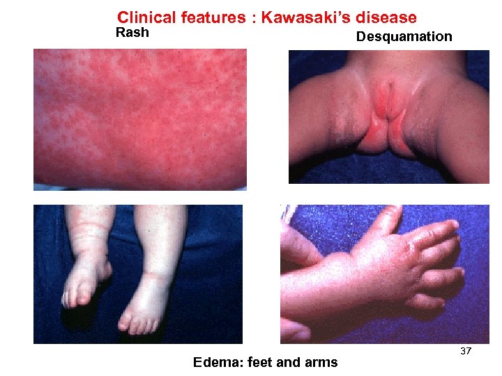 Clinical features : Kawasaki’s disease Rash Desquamation Edema: feet and arms 37 