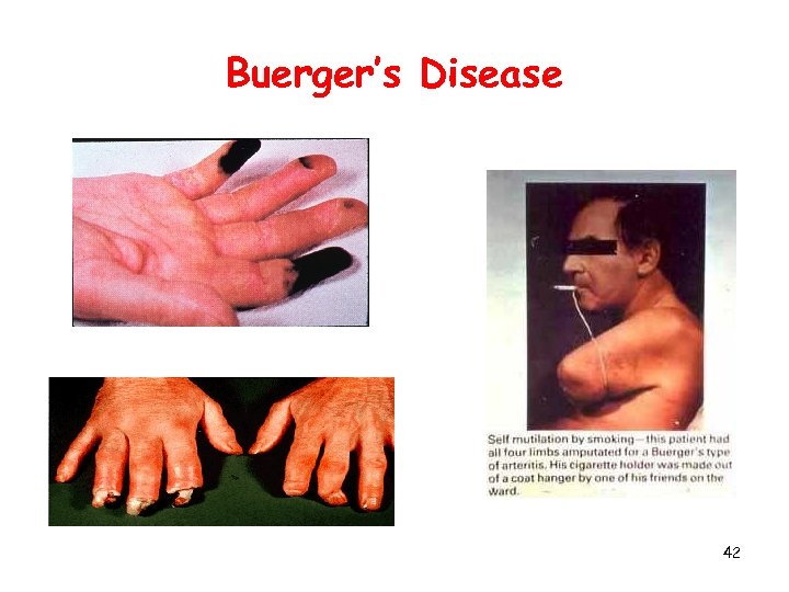 Buerger’s Disease 42 