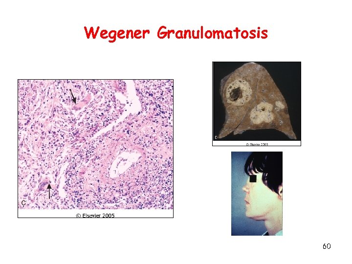 Wegener Granulomatosis 60 