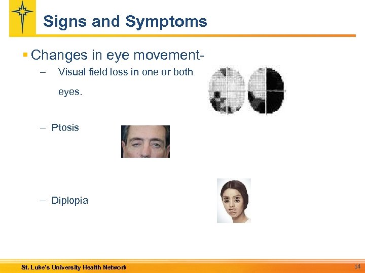 Signs and Symptoms § Changes in eye movement– Visual field loss in one or