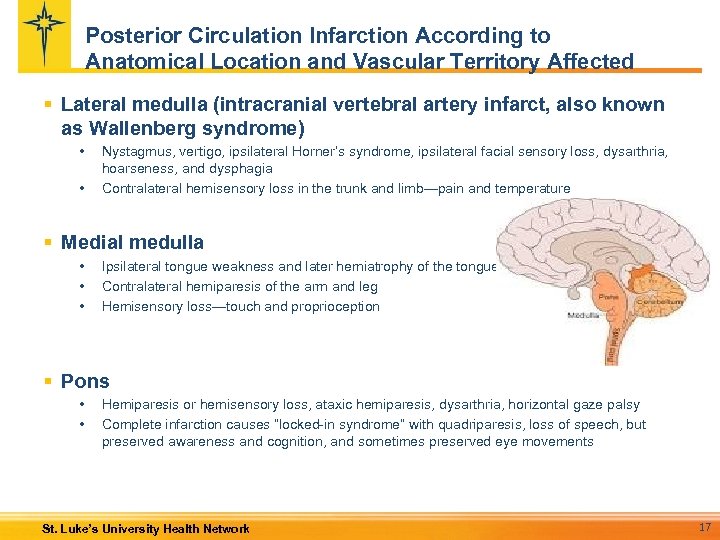 Posterior Circulation Infarction According to Anatomical Location and Vascular Territory Affected § Lateral medulla