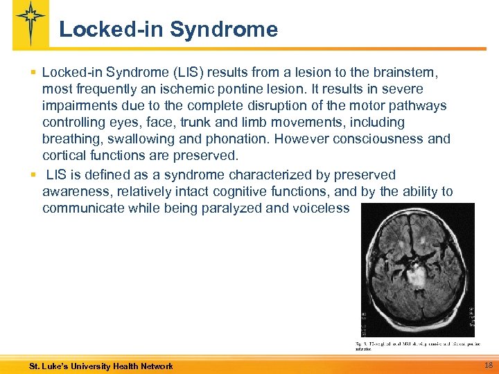 Locked-in Syndrome § Locked-in Syndrome (LIS) results from a lesion to the brainstem, most