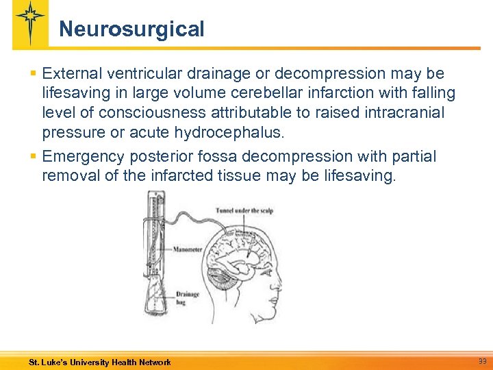 Neurosurgical § External ventricular drainage or decompression may be lifesaving in large volume cerebellar