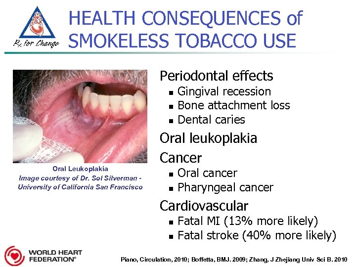 HEALTH CONSEQUENCES of SMOKELESS TOBACCO USE Periodontal effects n n n Oral Leukoplakia Image