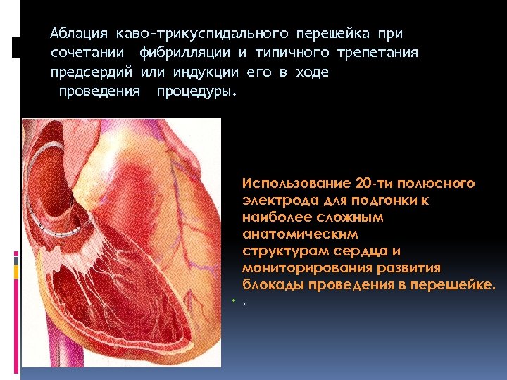 Аблация каво-трикуспидального перешейка при сочетании фибрилляции и типичного трепетания предсердий или индукции его в