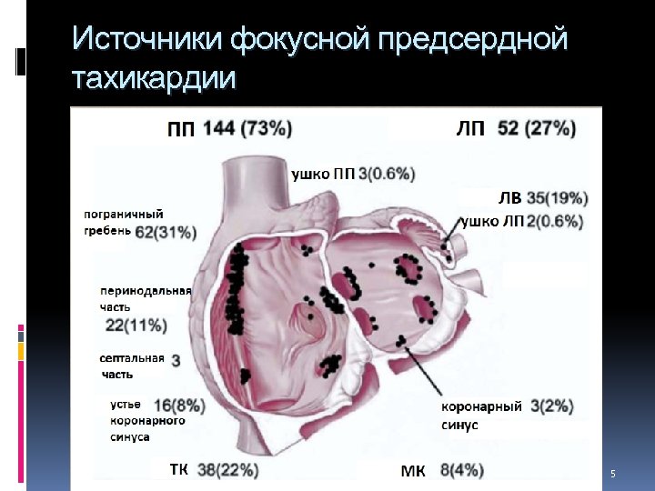 Источники фокусной предсердной тахикардии 5 