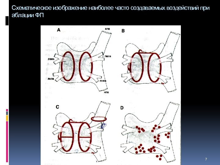 Схематическое изображение наиболее часто создаваемых воздействий при аблации ФП 7 