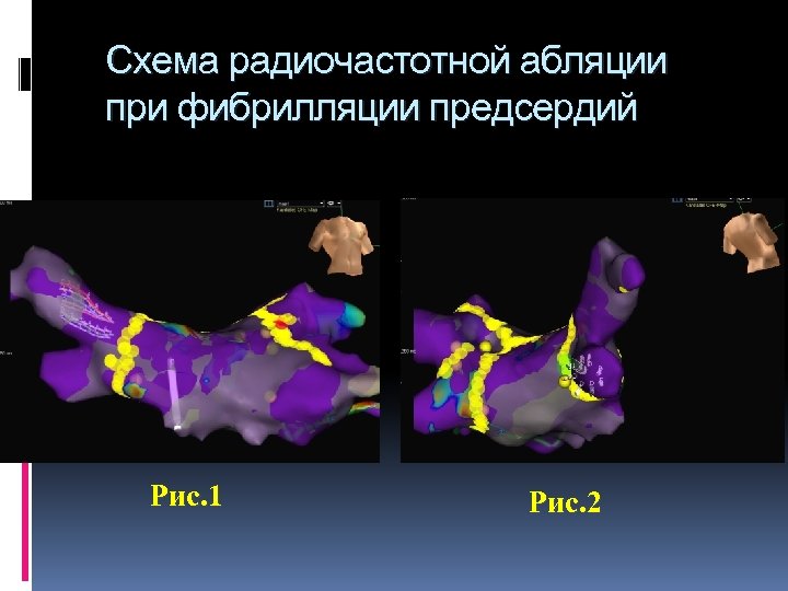 Схема радиочастотной абляции при фибрилляции предсердий Рис. 1 Рис. 2 