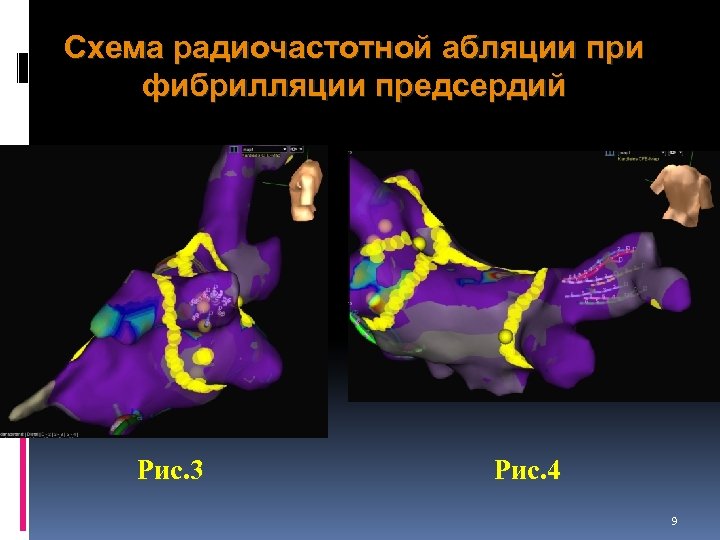 Схема радиочастотной абляции при фибрилляции предсердий Рис. 3 Рис. 4 9 