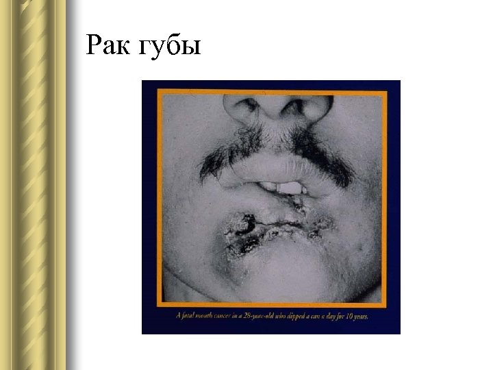 Рак губы 