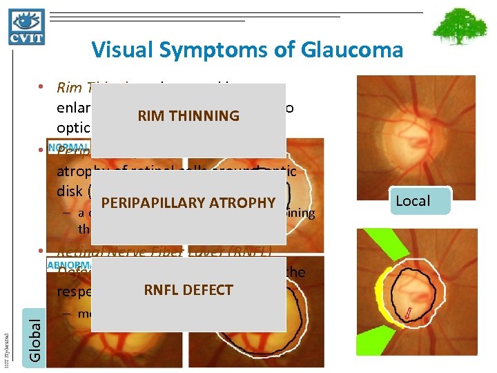 Visual Symptoms of Glaucoma • Rim Thinning – is caused by enlargement of cup